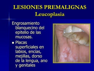 LESIONES PREMALIGNASLeucoplasiaEngrosamiento blanquecino del epitelio de las mucosas.Placas superficiales en labios, encías, mejillas, dorso de la lengua, ano y genitales