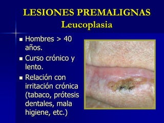 LESIONES PREMALIGNASLeucoplasiaHombres > 40 años.Curso crónico y lento.Relación con irritación crónica (tabaco, prótesis dentales, mala higiene, etc.)