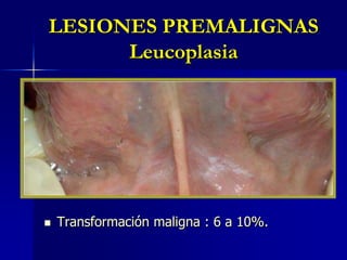 LESIONES PREMALIGNASLeucoplasiaTransformación maligna : 6 a 10%.