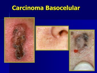 Carcinoma Basocelular
