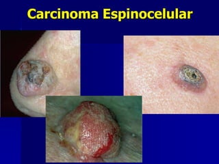 Carcinoma BasocelularUbicaciones más frecuentes