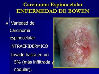 Carcinoma Basocelular