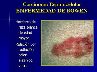 Carcinoma Espinocelular