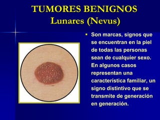 TUMORES BENIGNOS Lunares (Nevus)Son marcas, signos que se encuentran en la piel de todas las personas sean de cualquier sexo.En algunos casos representan una característica familiar, un signo distintivo que se transmite de generación en generación.TUMORES BENIGNOS AcrocordonesPequeños colgajos de piel suaves, blandos y de color carne, o ligeramente oscuros, que aparecen generalmente en el cuello, las axilas o las ingles. Por lo general son inofensivos, pero pueden resultar poco estéticos y además la ropa o la piel cercana puede rozarlos e irritarlos.