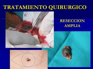 Carcinoma Espinocelular ENFERMEDAD DE BOWENHombres de raza blanca de edad mayor.Relación con radiación solar, arsénico, virus.