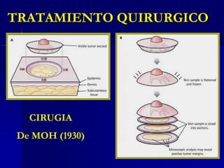 Carcinoma verugoso de Planta de pieVariante de carcinoma espinocelular, simula una verruga, es de crecimiento lento, cuando se ubica en la planta del pie se denomina “carcinoma cuniculatum”. Rara mestástasis.