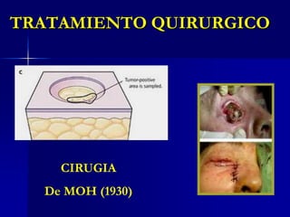 TRATAMIENTO QUIRURGICORESECCION AMPLIA