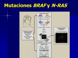MELANOMA1787 John Hunter primer caso descrito.1905 Samson Handley, Middlesex, Londres. The Lancet en 1907, base del tto. Por 50 años: resección 5 cm.