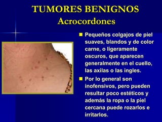 TUMORES BENIGNOS AngiomasAcumulaciones de vasos sanguíneos o linfáticos anormalmente densos que, por lo general, se localizan en la piel y por debajo de ella y producen una coloración roja o púrpura. TUMORES BENIGNOS Angiomas: nevi flammeusiManchas de vino de Oporto:  manchas planas de color rosado, rojo o violáceo presentes en el momento de nacer. TUMORES BENIGNOS Hemangiomas cavernososTumores abultados rojos o violáceos formados por vasos sanguíneos anormales y agrandados presentes en el momento del nacimiento. A veces se dolorosos y hemorrágicos, después de lo cual pueden desaparecer parcialmente. Rara vez desaparecen por completo sin tratamiento.