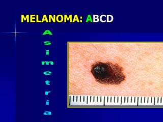 TEORIA DE MELANOMA INDUCIDO POR  UVDemierre, M.-F. et al. J Clin Oncol; 21:158-165 2003