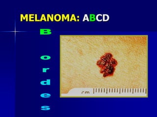 CDKN2A Codifica dos proteínas con lecturas alternantes:: p16ink4a y p14ARFDemierre, M.-F. et al. J Clin Oncol; 21:158-165 2003