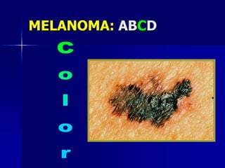 MELANOMA:ABCDAsimetría