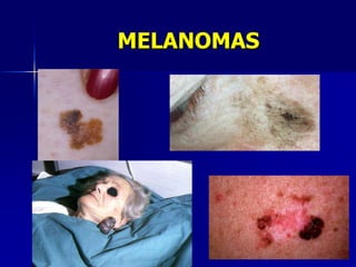 MELANOMA: ABCDColor
