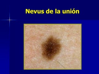Nevus Congénito