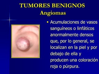 TUMORES BENIGNOS Angiomas: arañas vasculares Áreas de color rojo brillante, presentan una mancha central entre rojiza y violácea con delgadas proyecciones que se asemejan a patas de araña. Al presionar sobre el punto central (el vaso sanguíneo que es el suministro de sangre en un angioma en araña) el color puede palidecer temporalmente.