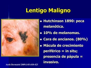 Nevus de la unión