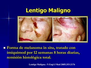Lentigo MalignoHutchinson 1890: peca melanótica.10% de melanomas.Cara de ancianos. (80%)Mácula de crecimiento periférico = in situ; presencia de pápula = invasivo.Arch Dermatol 2009;145:418-423 