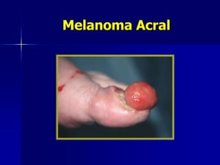 Lentigo MalignoForma de melanoma in situ, tratado con imiquimod por 12 semanas 8 horas diarias, remisión histológica total.Lentigo Maligna.- N Engl J Med 2005;353:2176