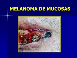 Acrolentiginoso/mucosoPlantas, palmas, uñas y mucosas.  En torno a primario cambio lentiginoso.Melanoma Acral