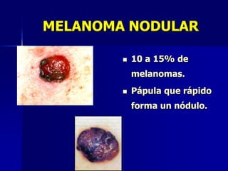 MELANOMA DE MUCOSAS