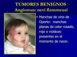 TUMORES BENIGNOS Angiomas: Hemangiomas capilaresTumores abultados de color rojo brillante cuyo diámetro oscila entre 1 y 10 cm.Aparecen poco después del nacimiento y crecen lentamente durante los primeros meses de vida. Más de 3/4 partes desaparecen por completo a los 7 años, algunas dejan un área arrugada y de color pardusco.