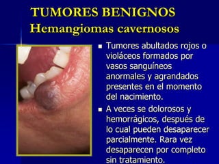 TUMORES BENIGNOS Dermatofibromas Tumores pequeños (nódulos) de color rojo a pardo que derivan de una acumulación de fibroblastos, unas células localizadas en el tejido blando que está por debajo de la piel. 