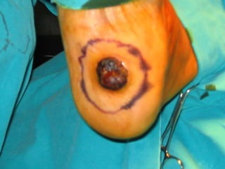 DISECCIÓN LINFÁTICA La Mayoría no ganglios palpables.