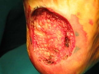  20% metástasis ocultas ganglionares.