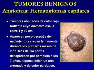 TUMORES BENIGNOS Rinofimia<br /><ul><li>Hipertrofia de glándulas sebáceas.