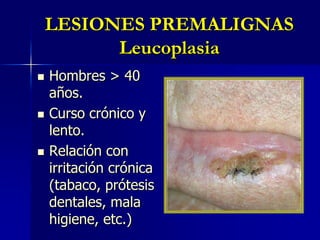 LESIONES PREMALIGNASLeucoplasia<br />Hombres > 40 años.<br />Curso crónico y lento.<br />Relación con irritación crónica (...