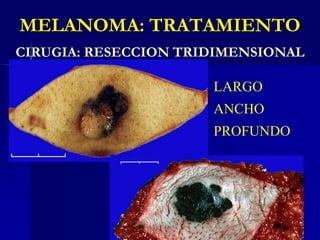 http://www.nccn.org/professionals/physician_gls/PDF/melanoma.pdf<br />