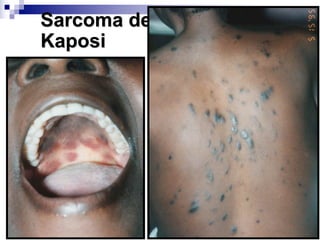 Sarcoma de
Kaposi
 