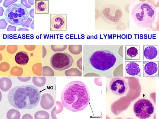 DISEASES of WHITE CELLS and LYMPHOID TISSUE 
 