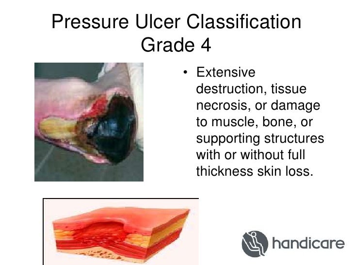 Reducing the incidence of pressure sores and shearing damage for bed…