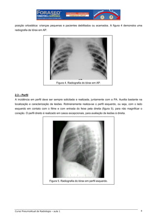 posição ortostática: crianças pequenas e pacientes debilitados ou acamados. A figura 4 demonstra uma
radiografia de tórax em AP.

Figura 4. Radiografia do tórax em AP.

2.3 – Perfil
A incidência em perfil deve ser sempre solicitada e realizada, juntamente com a PA. Auxilia bastante na
localização e caracterização de lesões. Rotineiramente realiza-se o perfil esquerdo, ou seja, com o lado
esquerdo em contato com o filme e com entrada do feixe pela direita (figura 5), para não magnificar o
coração. O perfil direito é realizado em casos excepcionais, para avaliação de lesões à direita.

Figura 5. Radiografia do tórax em perfil esquerdo.

Curso PneumoAtual de Radiologia – aula 1

4

 