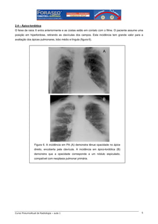 2.4 – Ápico-lordótica
O feixe de raios X entra anteriormente e as costas estão em contato com o filme. O paciente assume uma
posição em hiperlordose, retirando as clavículas dos campos. Esta incidência tem grande valor para a
avaliação dos ápices pulmonares, lobo médio e língula (figura 6).

A

B

Figura 6. A incidência em PA (A) demonstra tênue opacidade no ápice
direito, encoberta pela clavícula. A incidência em ápico-lordótica (B)
demonstra que a opacidade corresponde a um nódulo espiculado,
compatível com neoplasia pulmonar primária.

Curso PneumoAtual de Radiologia – aula 1

5

 