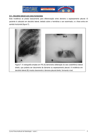 2.5 – Decúbito lateral com raios horizontais
Esta incidência se presta basicamente para diferenciação entre derrame e espessamento pleural. O
paciente é colocado em decúbito lateral, deitado sobre o hemitórax a ser examinado, e o feixe entra em
sentido horizontal (figura 7).

A

B

Figura 7. A radiografia simples em PA (A) demonstra obliteração do seio costofrênico lateral
direito, que poderia ser decorrente de derrame ou espessamento pleural. A incidência em
decúbito lateral (B) mostra claramente o derrame pleural direito, formando nível.

Curso PneumoAtual de Radiologia – aula 1

6

 
