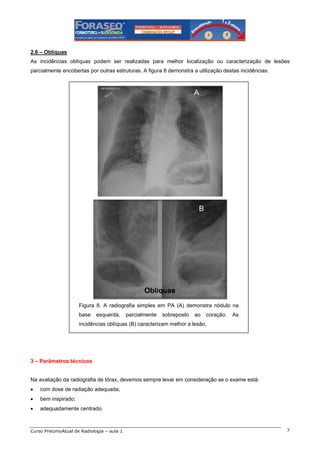 2.6 – Oblíquas
As incidências oblíquas podem ser realizadas para melhor localização ou caracterização de lesões
parcialmente encobertas por outras estruturas. A figura 8 demonstra a utilização destas incidências.

A

B

Figura 8. A radiografia simples em PA (A) demonstra nódulo na
base

esquerda,

parcialmente

sobreposto

ao

coração.

As

incidências oblíquas (B) caracterizam melhor a lesão.

3 – Parâmetros técnicos

Na avaliação da radiografia de tórax, devemos sempre levar em consideração se o exame está:
•

com dose de radiação adequada;

•

bem inspirado;

•

adequadamente centrado.

Curso PneumoAtual de Radiologia – aula 1

7

 