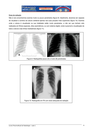 Dose de radiação
Não é raro encontrarmos exames muito ou pouco penetrados (figura 9). Idealmente, devemos ser capazes
de visualizar a sombra da coluna vertebral apenas nas suas porções mais superiores (figura 10). Exames
onde a coluna é visualizada na sua totalidade estão muito penetrados, a não ser que tenham sido
realizados em filmes especiais, ditos assimétricos, ou com sistema digital, onde é possível a visualização de
toda a coluna e das linhas mediastinais (figura 11).

A

B
Figura 9. Radiografias pouco (A) e muito (B) penetradas.

Figura 10. Radiografia em PA com dose adequada de radiação.

Curso PneumoAtual de Radiologia – aula 1

8

 