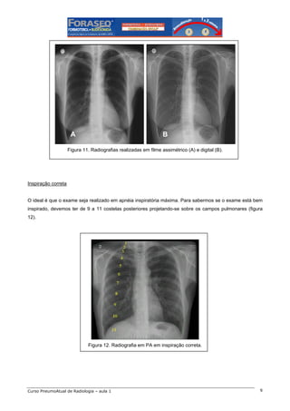 A

B

Figura 11. Radiografias realizadas em filme assimétrico (A) e digital (B).

Inspiração correta

O ideal é que o exame seja realizado em apnéia inspiratória máxima. Para sabermos se o exame está bem
inspirado, devemos ter de 9 a 11 costelas posteriores projetando-se sobre os campos pulmonares (figura
12).

Figura 12. Radiografia em PA em inspiração correta.

Curso PneumoAtual de Radiologia – aula 1

9

 