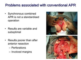 Problems associated with conventional APR Synchronous combined APR is not a standardised operation Results are variable and suboptimal Results poorer than after anterior resection Perforations Involved margins 