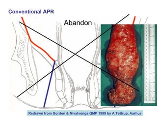 Abdominoperineal Resection Conventional APR Abandon Redrawn from Gordon & Nivatvongs QMP 1999 by A.Tøttrup, Aarhus 