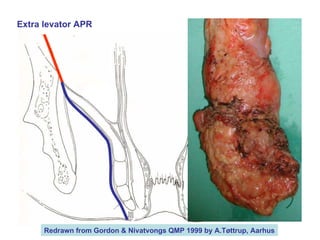 Extra levator APR Redrawn from Gordon & Nivatvongs QMP 1999 by A.Tøttrup, Aarhus 