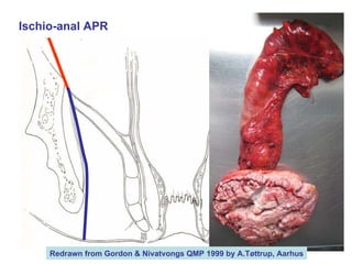 Ischio-anal APR Redrawn from Gordon & Nivatvongs QMP 1999 by A.Tøttrup, Aarhus 