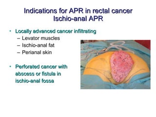 Indications for APR in rectal cancer Ischio-anal APR Locally advanced cancer infiltrating Levator muscles Ischio-anal fat Perianal skin Perforated cancer with abscess or fistula in ischio-anal fossa 