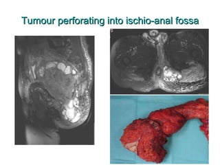 Tumour perforating into ischio-anal fossa 