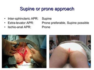 Supine or prone approach Inter-sphincteric APR: Supine Extra-levator APR: Prone preferable, Supine possible Ischio-anal APR: Prone  