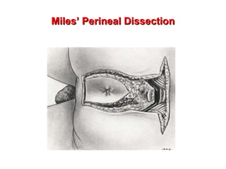 Miles’ Perineal Dissection 