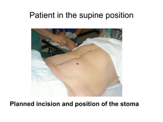 Patient in the supine position Planned incision and position of the stoma 