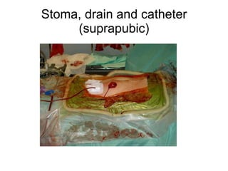 Stoma, drain and catheter (suprapubic) 
